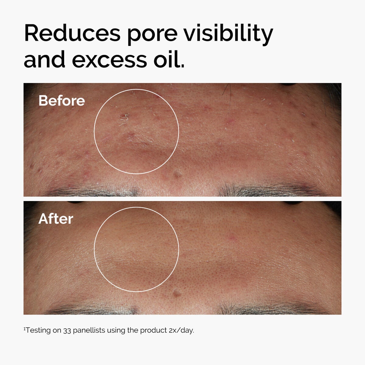niacinamide-10-zinc-1-o2 ord-niacinamide-zinc-blemish-serum-before-after-pores.jpg