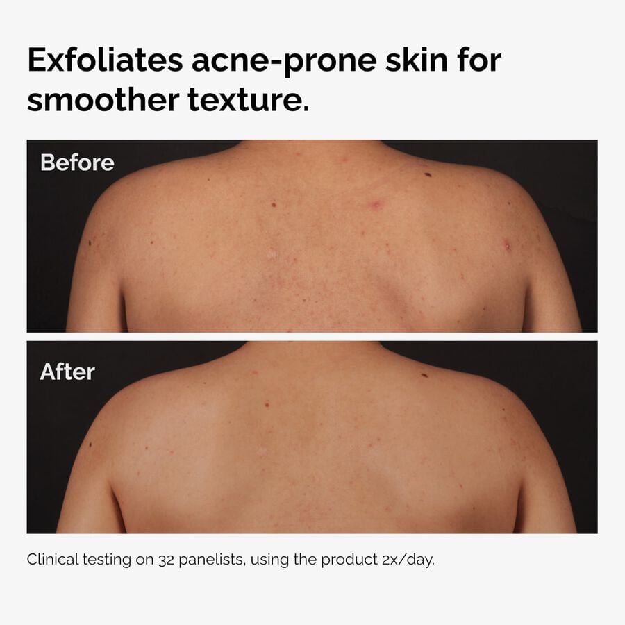 the-body-care-collection-k3 ord-salicylic-acid-body-serum-before-after-graphic-NA.jpg