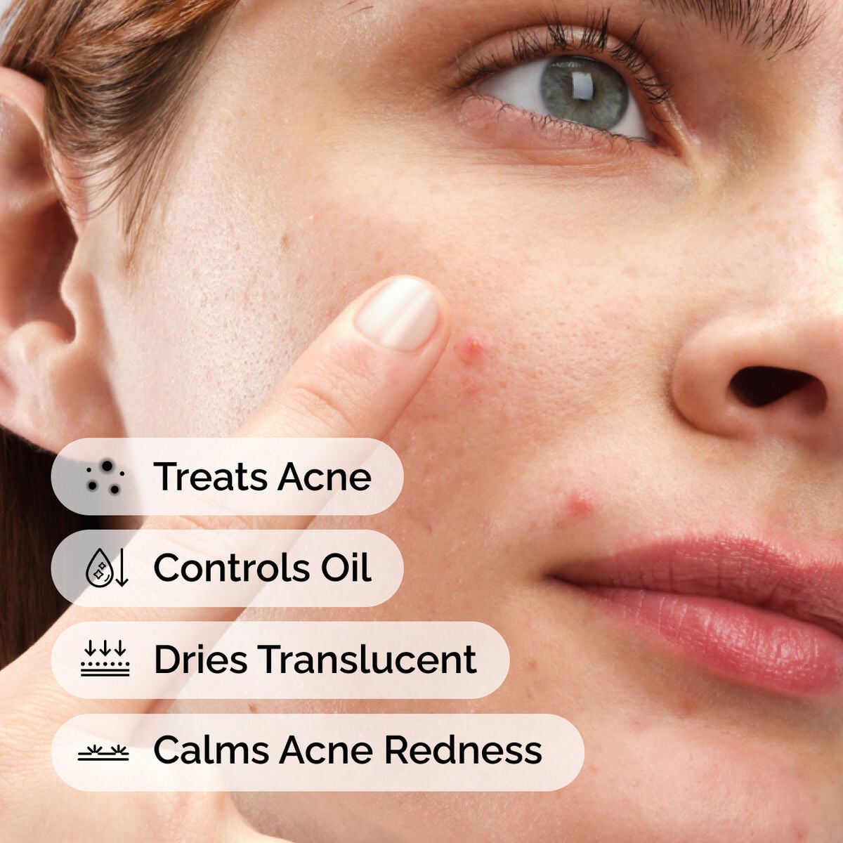 sulfur-10-powder-to-cream-concentrate-t1 ord-sulfur-10pct-powder-to-cream-concentrate-model-application-with-benefits-acne.jpg