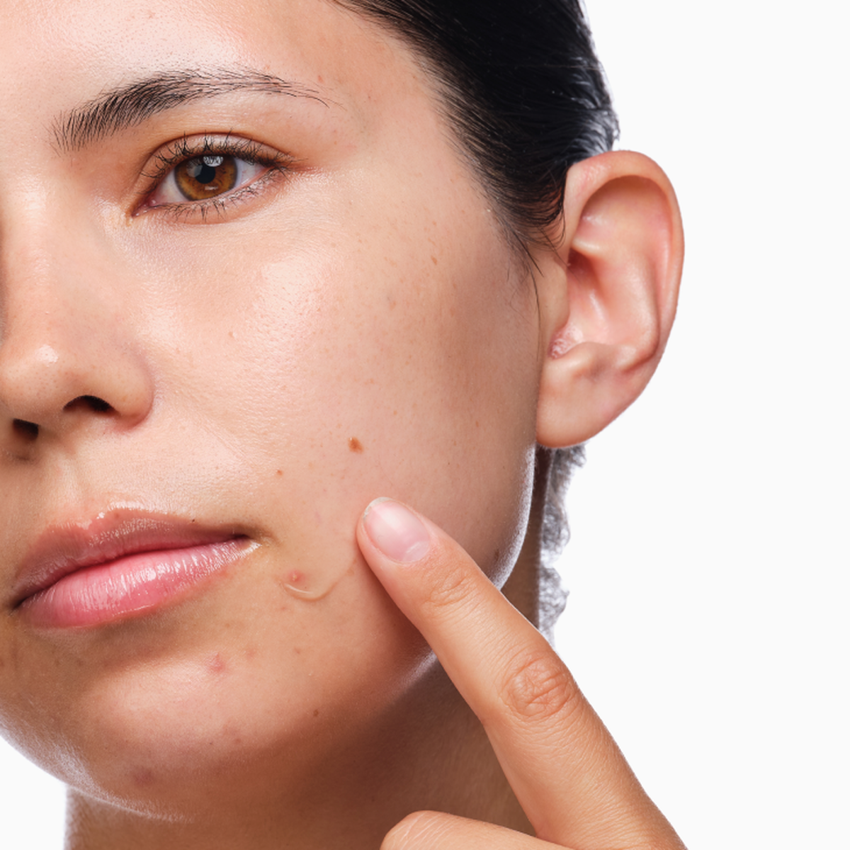 the-acne-set-n6 rdn-the-acne-set-application.png